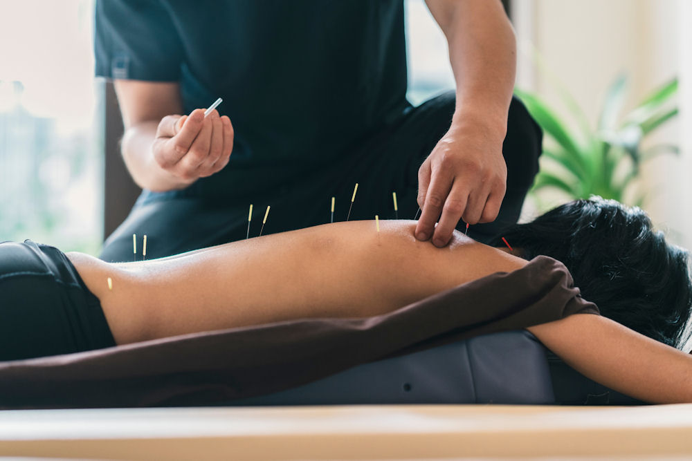 girl undergoing acupuncture therapy for healing